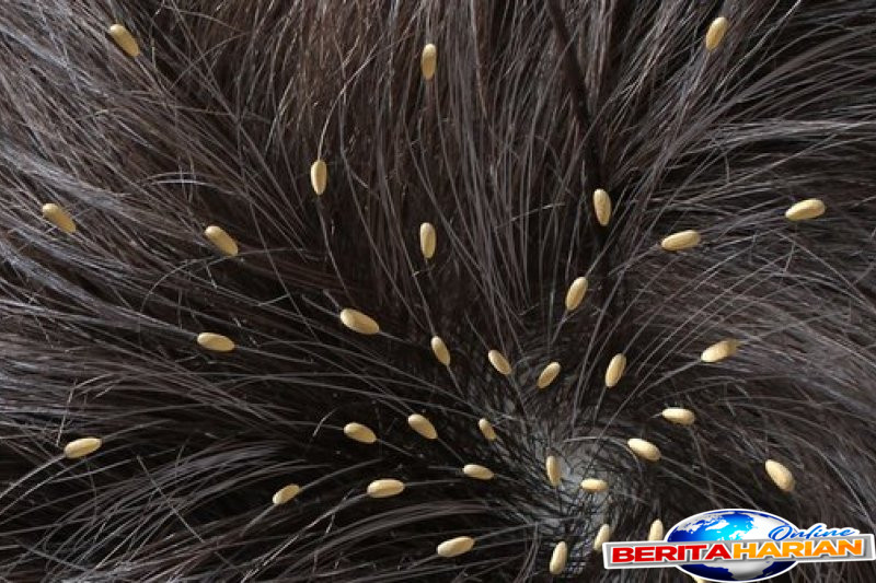 Kutu Memicu Berbagai Penyakit dan Cara Pencegahannya 1 kutu bisa picu sejumlah penyakit dan kenali cara mencegahnya